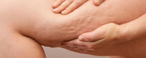 Tratamiento Celulitis