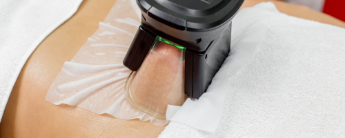 Tratamiento Criolipólisis