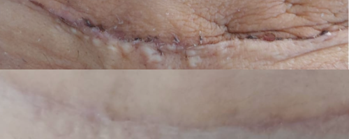 Tratamiento Post Operatorio