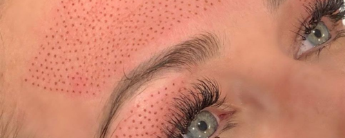 PLASMED O FIBROBLAST